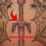 Dermal Anchor; Implantat